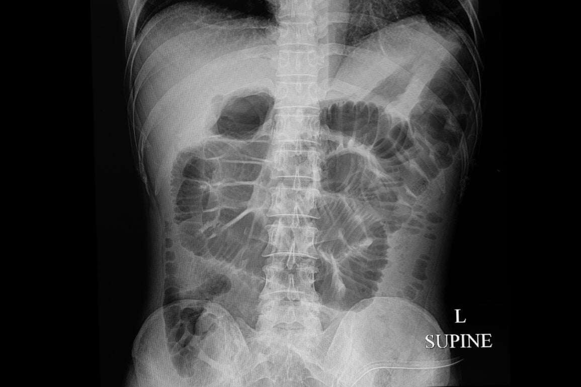 Abdominal Radiograph Interpretation Oscestop Osce Learning