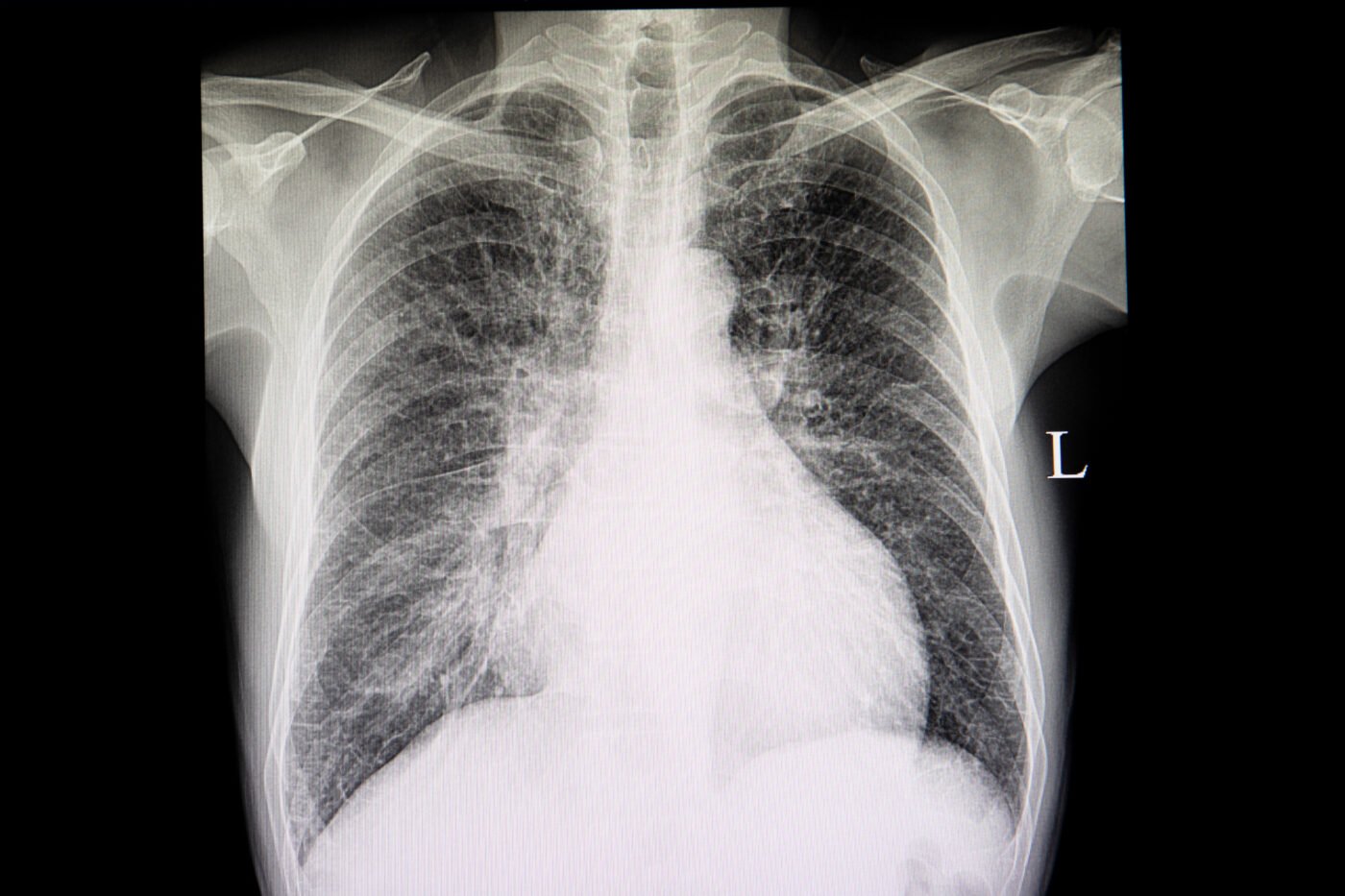 Chest Radiograph Interpretation Oscestop Osce Learning