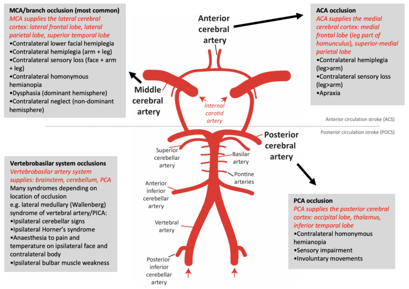 Stroke Oscestop Osce Learning