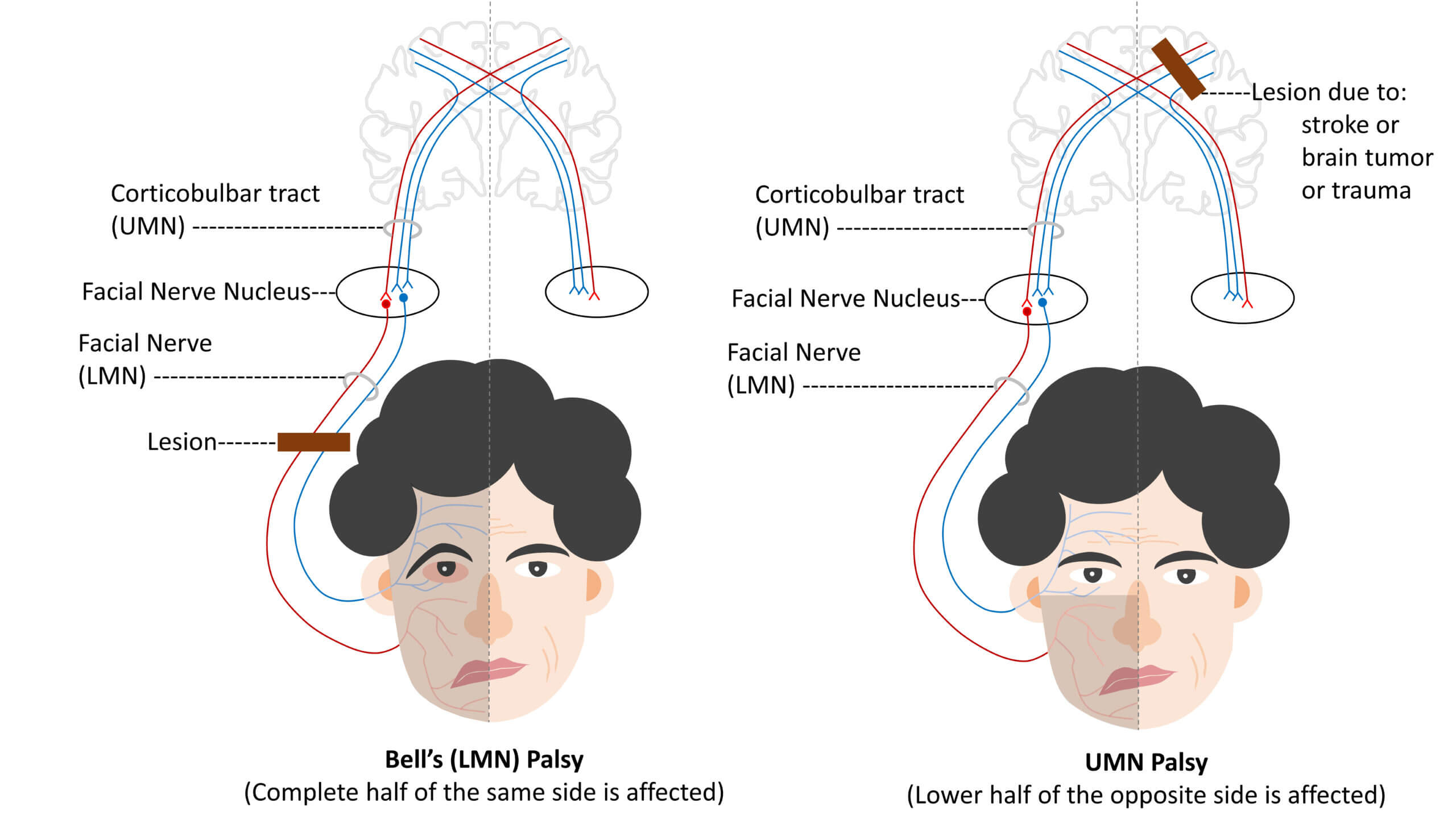 Facial nerve Palsy (LMN Type)