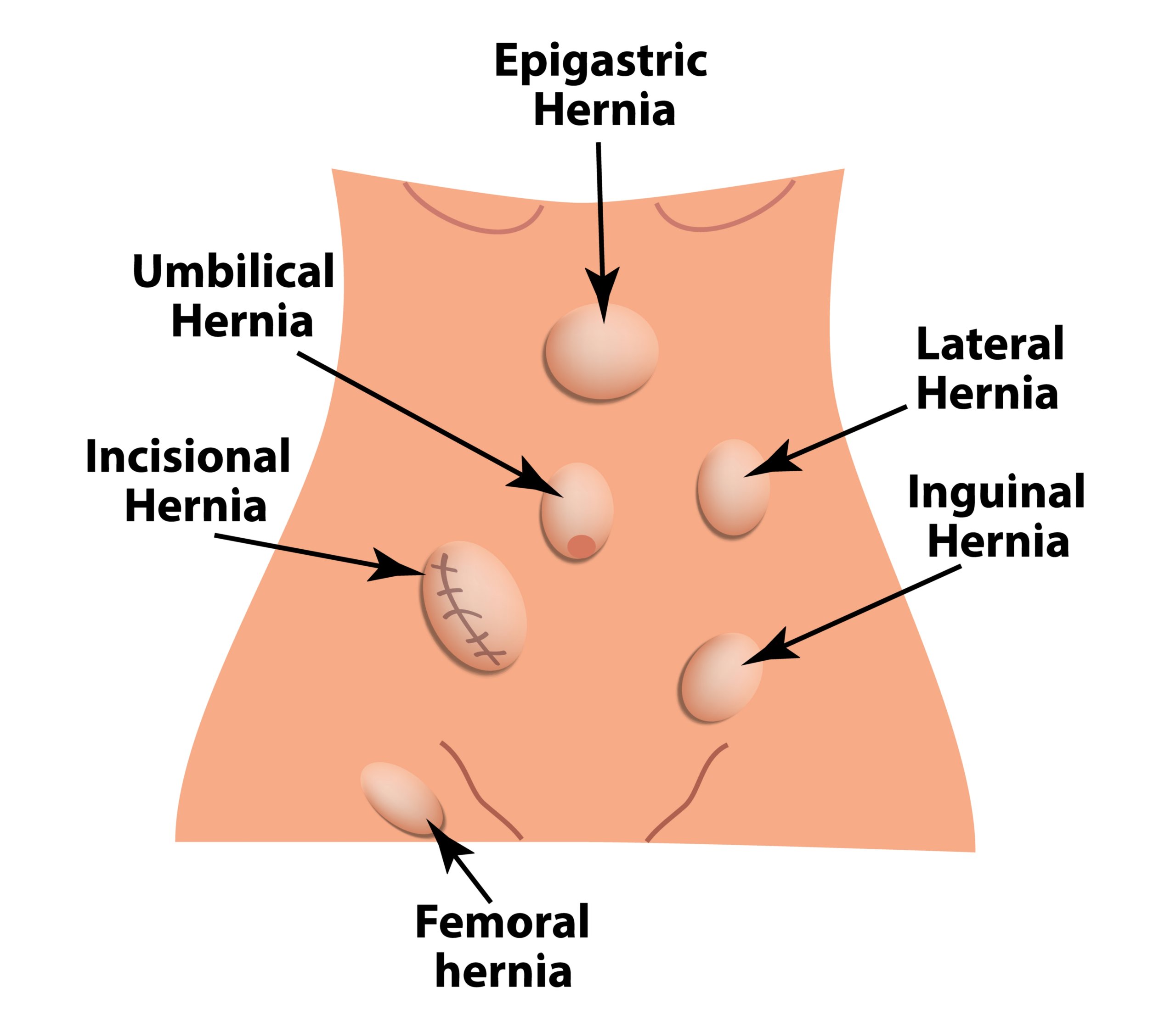 Anatomy of Inguinal Canal | PDF | Musculoskeletal System | Abdomen