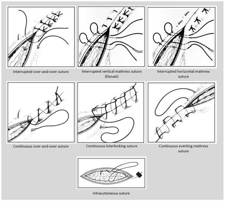 Suturing Technique Oscestop Osce Learning