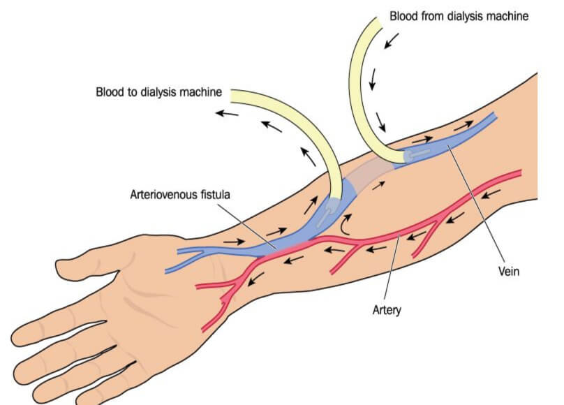 Arteriovenous fistula – OSCEstop